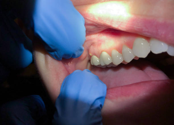 Best Emergency Dental Care for Abscessed Tooth in Casper, WY